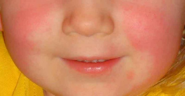 SCARLET FEVER IS BACK AND EVERY PARENT NEEDS TO WATCH OUT FOR THESE WARNING SIGNS