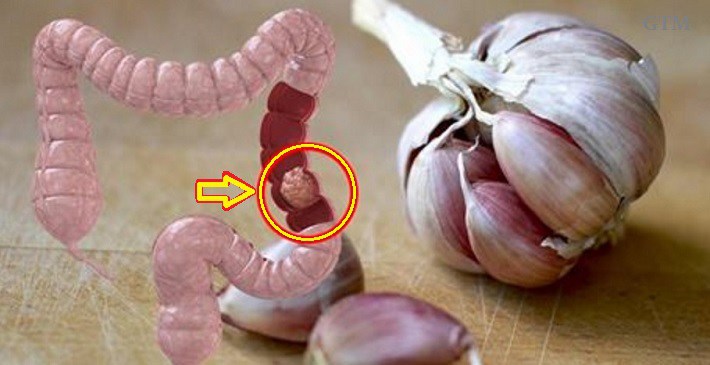 50% OF ALL COLON CANCER CASES CAN BE AVOIDED IF WE STAY AWAY FROM THESE 9 THINGS