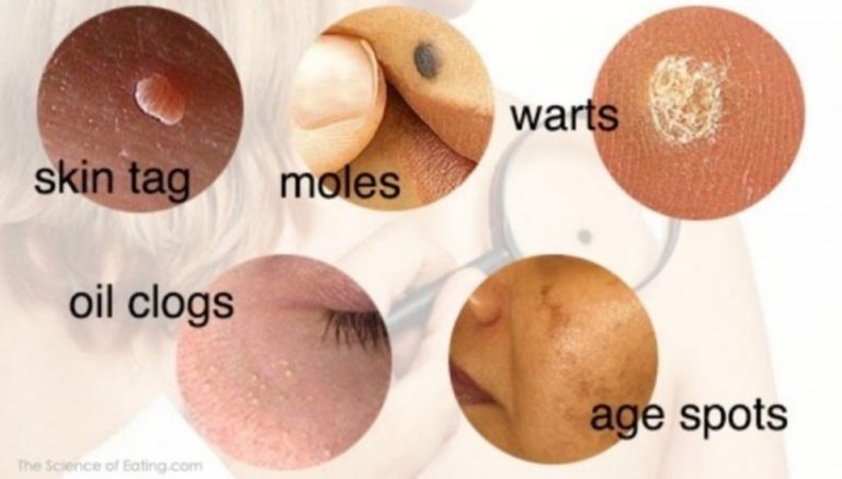 HOW TO REMOVE MOLES, WARTS, BLACKHEADS, SKIN TAGS, AND AGE SPOTS COMPLETELY NATURALLY!