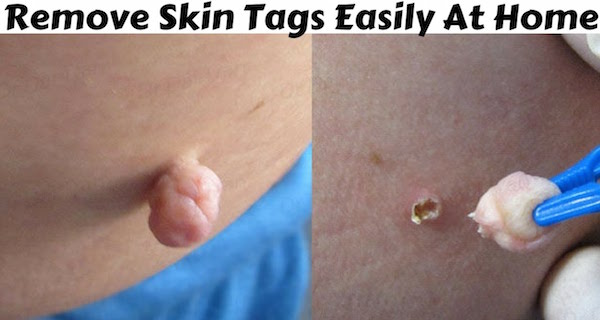 TOP 5 HOME REMEDIES TO REMOVE SKIN TAGS – VIDEO