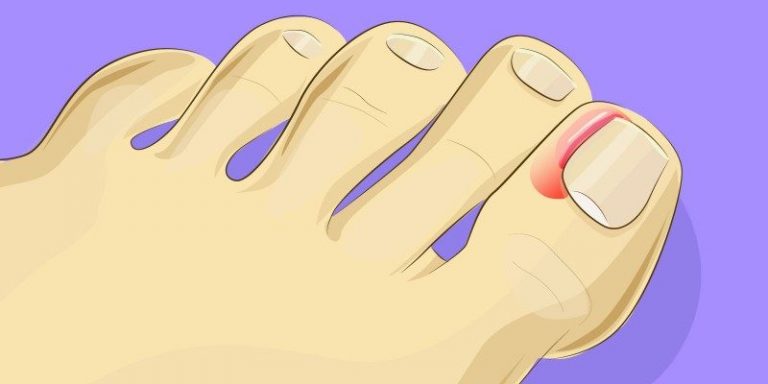 IT’S THIS EASY TO CARE FOR INGROWN TOENAILS AT HOME. NO NEED FOR AN OPERATION!