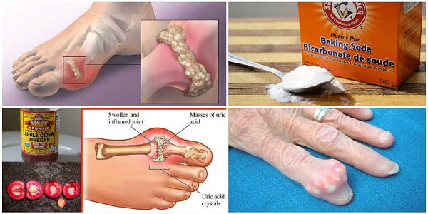 HOW TO QUICKLY REMOVE URIC ACID CRYSTALLIZATION FROM YOUR BODY TO PREVENT GOUT AND JOINT PAIN