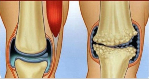 6 NATURAL ANTI-INFLAMMATORY REMEDIES THAT CAN TREAT AND CURE JOINT AND KNEE PAIN!