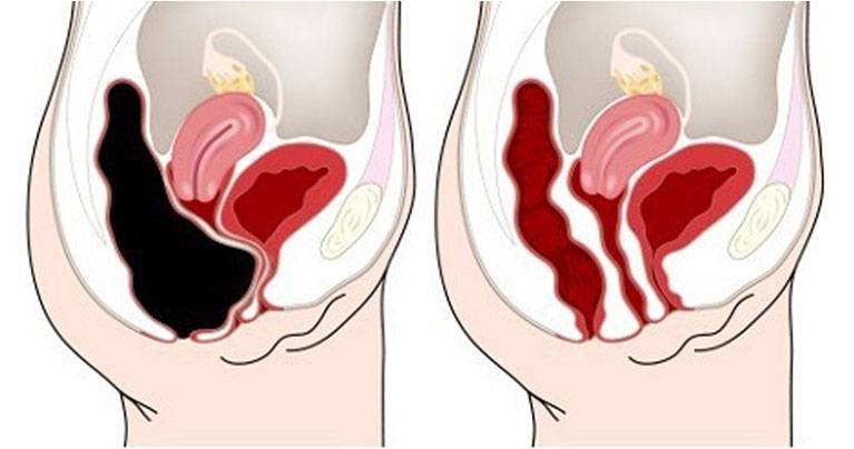 HOW TO REMOVE POUNDS OF TOXIC WASTE FROM YOUR COLON – RECIPE