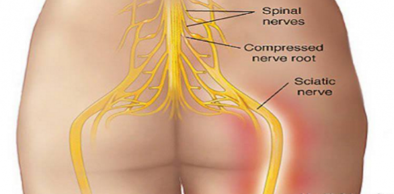 SUCCESSFUL IN 95%, THIS IS THE NATURAL WAY OF SAYING GOODBYE TO BACK PAIN