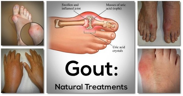 GOUT: POWERFUL NATURAL TREATMENT!
