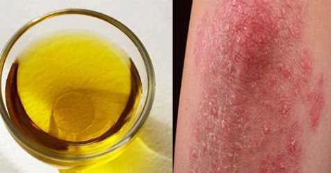 THE OIL THAT TREATS PSORIASIS, FUNGUS, COLD SORES, ACNE AND MUCH MORE