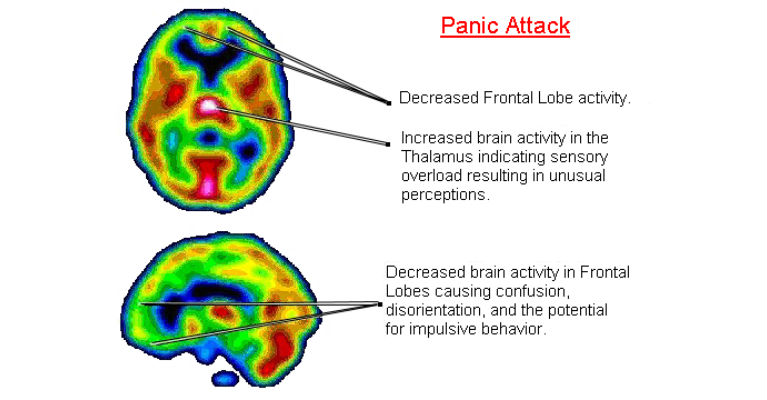 PANIC ATTACKS AND ANXIETY LINKED TO LOW VITAMIN B6 AND IRON LEVELS