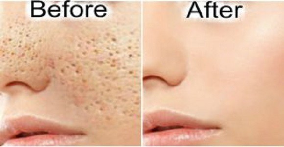 3 DAYS AND ALL OPEN PORES WILL DISAPPEAR FROM YOUR SKIN FOREVER