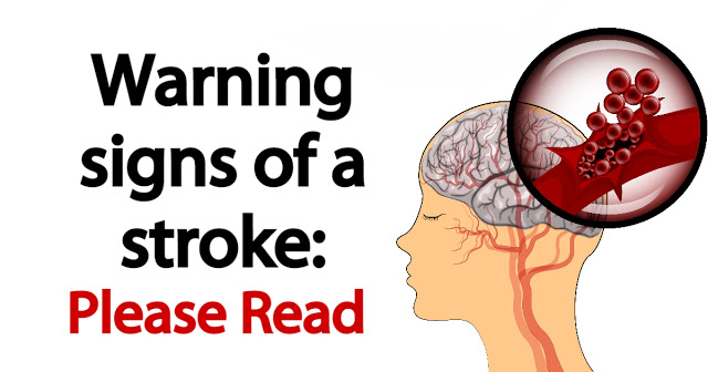 WARNING SIGNS OF A STROKE YOU MUST KNOW