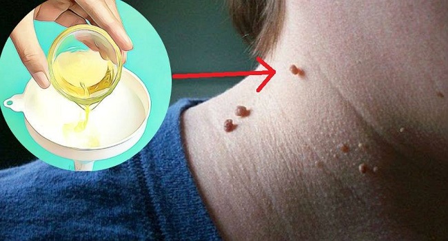 HOW TO REMOVE FIBROMA AND OTHER SKIN WARTS ALL BY YOURSELF?