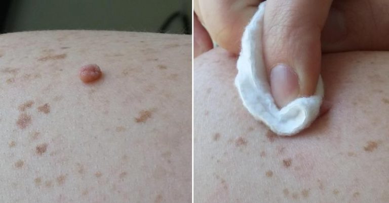 USE APPLE CIDER VINEGAR TO REMOVE SKIN TAGS