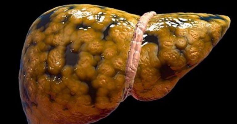 FATTY LIVER DOESN’T SHOW UP IN SCANS UNTIL IT’S TOO LATE. HERE ARE 7 EARLY WARNING SIGNS TO LOOK OUT FOR
