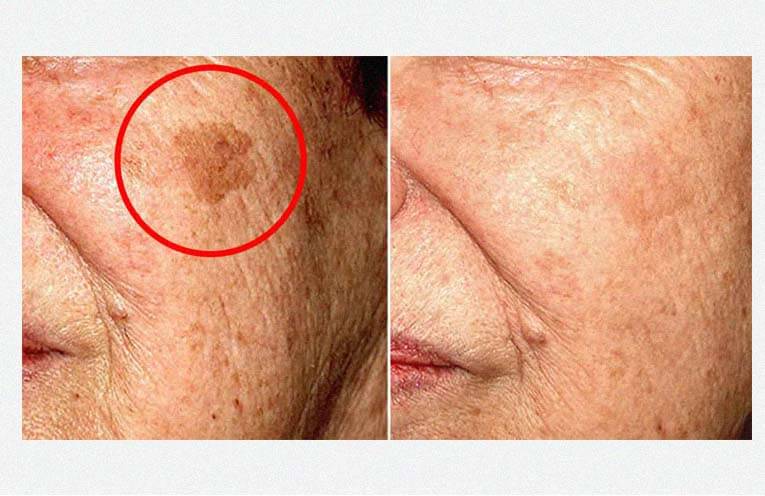 5 HOME REMEDIES TO REMOVE ANY TYPE OF SKIN SPOT FROM YOUR FACE