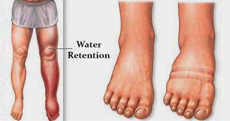 WHAT CAUSES WATER RETENTION AND HOW TO AVOID IT