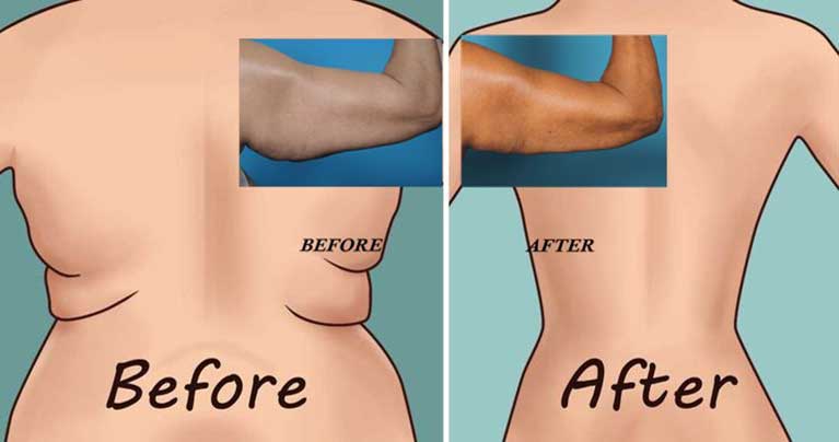 TRY THE 6 WORLD’S EASIEST EXERCISES FOR BACK FAT AND UNDERARM FLAB