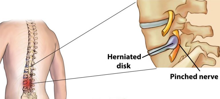 HOME REMEDIES FOR A PINCHED NERVE