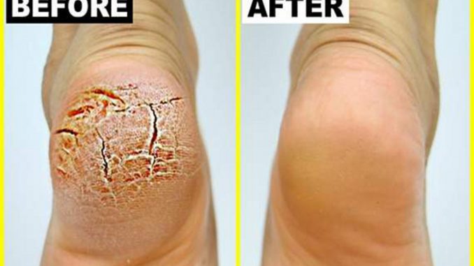 GRANDMA TOLD ME THIS TRICK. IT HEALED MY CRACKED HEELS IN JUST A FEW DAYS