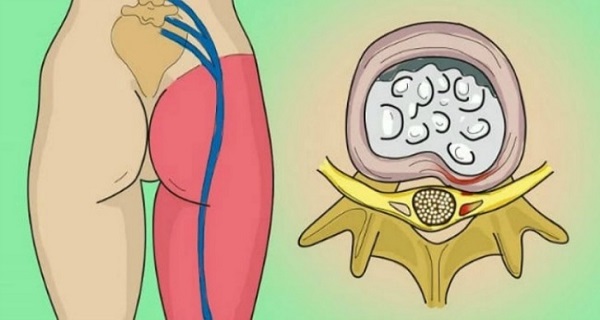 How to Release the Pinched Nerve in the Lumbar Area (sciatica)- 2 Simple Ways to Get Rid of the Pain