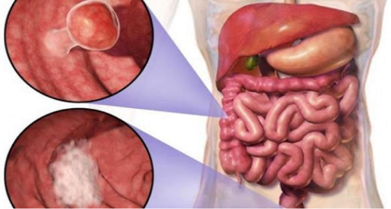 Millions At Risk Of Colon Cancer After Weight Loss Surgery, New Study