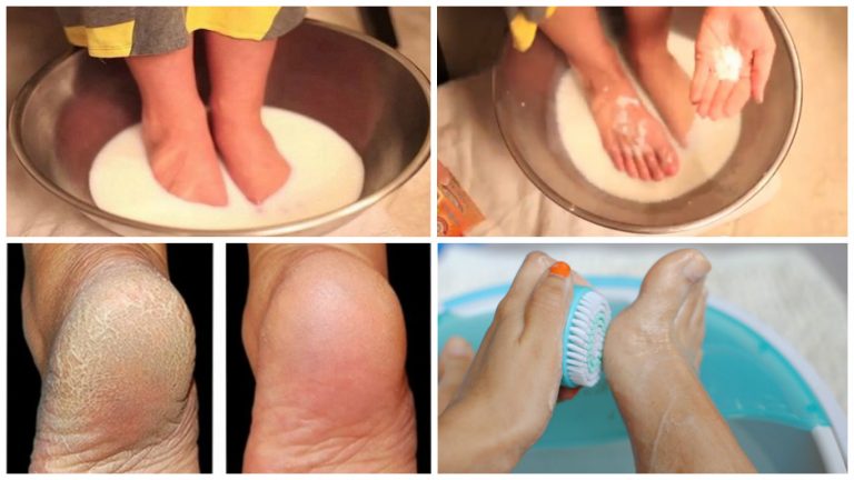 Don’t Spend on Pedicure: Use Two Ingredients from Your Kitchen and Make Your Feet Look Nice