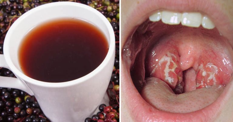 Strep Throat: 10 Natural Remedies