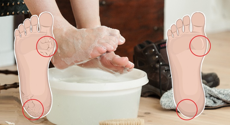 Soak your feet in this powerful baking soda mixture 2x each week to heal dry and cracked feet