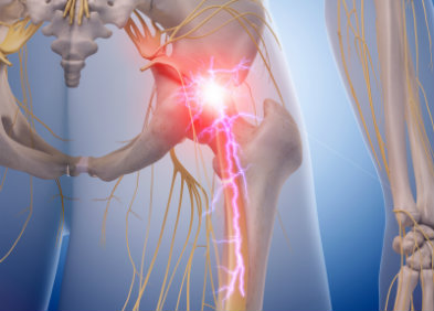 Easy And Quick Fixes For Sciatica Pain: Instant Relief You Can’t Miss