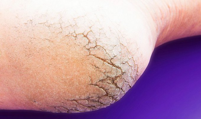 DON’T WASTE MONEY ON PEDICURES ANYMORE — WITH JUST TWO KITCHEN INGREDIENTS, YOUR FEET WILL LOOK BETTER THAN THEY HAVE IN A LONG TIME