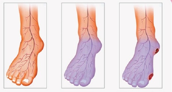 Poor Blood Circulation, Cold Hands and Legs? Here is What You Can Do to Solve This Problem