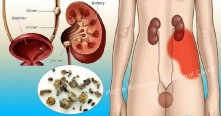 If You Frequently Have The Urge To Pee Especially In The Night, Than You May Need To Do A Kidney Cleanse