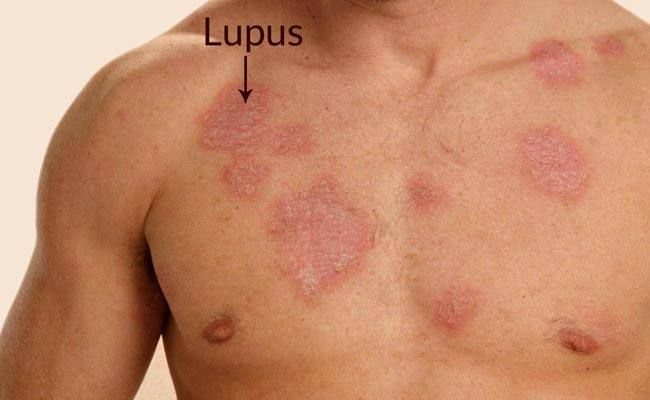 5 STRANGE FACTS ABOUT LUPUS YOU MUST KNOW