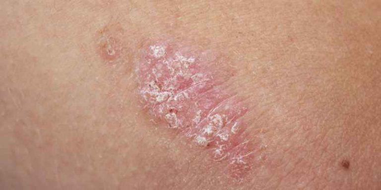 8 Strategies to Eliminate Psoriasis (Proven)