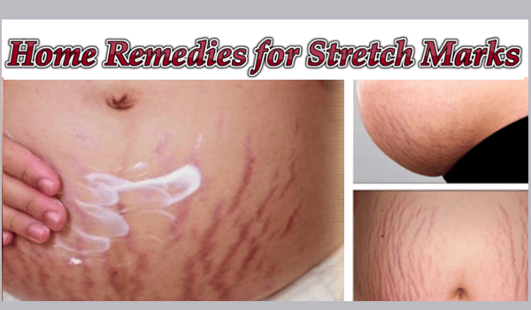 Stretch Marks Removal: 10 Best Home Remedies for Stretch Marks