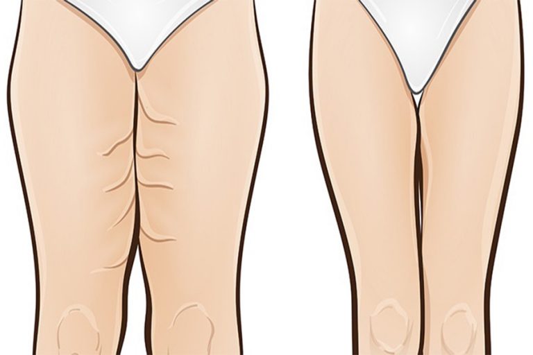 Five Effective Exercises For Slimmer Thighs In Only One Week